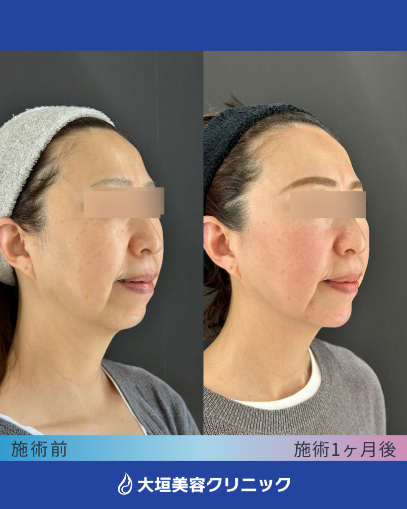 顎ヒアルロン酸＋糸リフト（アルテミスリフト6本）