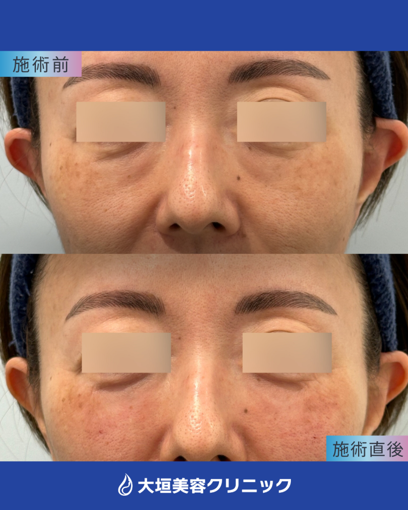 ゴルゴラインヒアルロン酸＋目の下ベビーコラーゲン