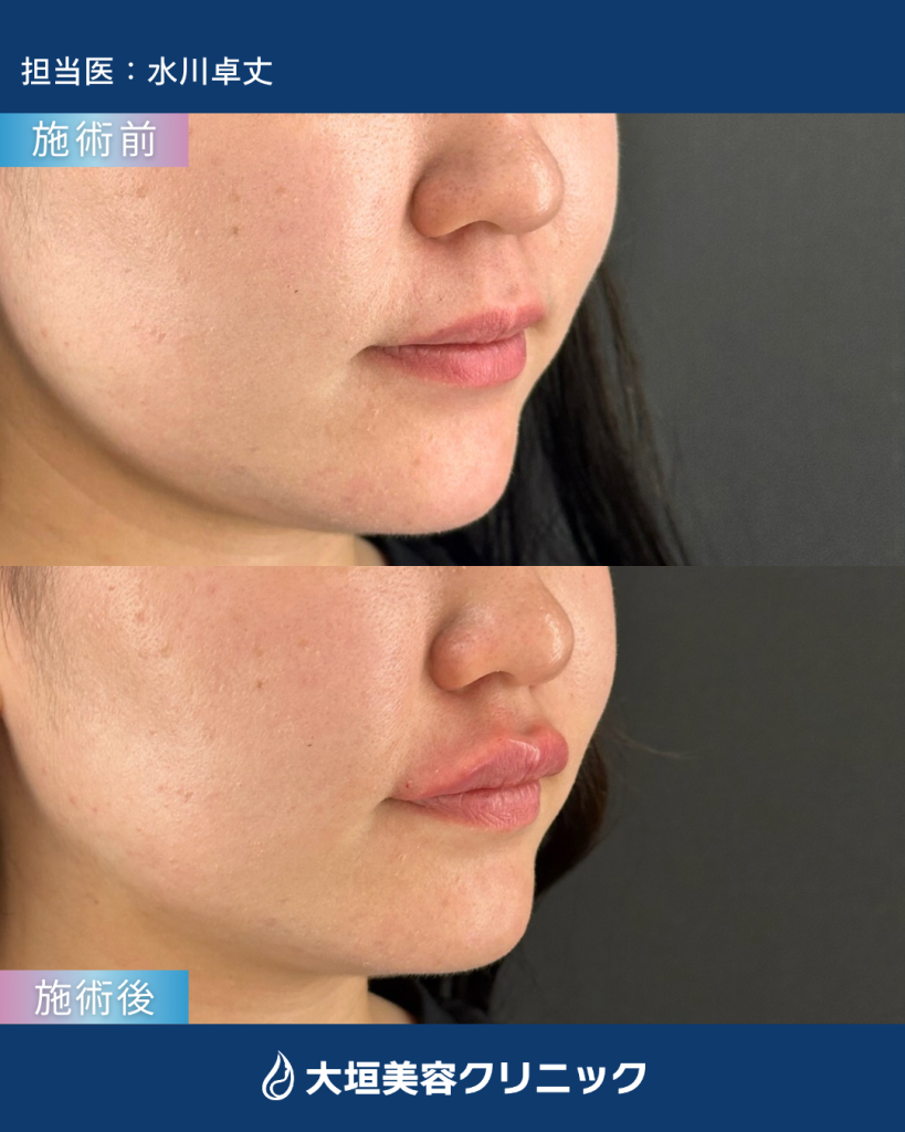 唇ヒアルロン酸⑤