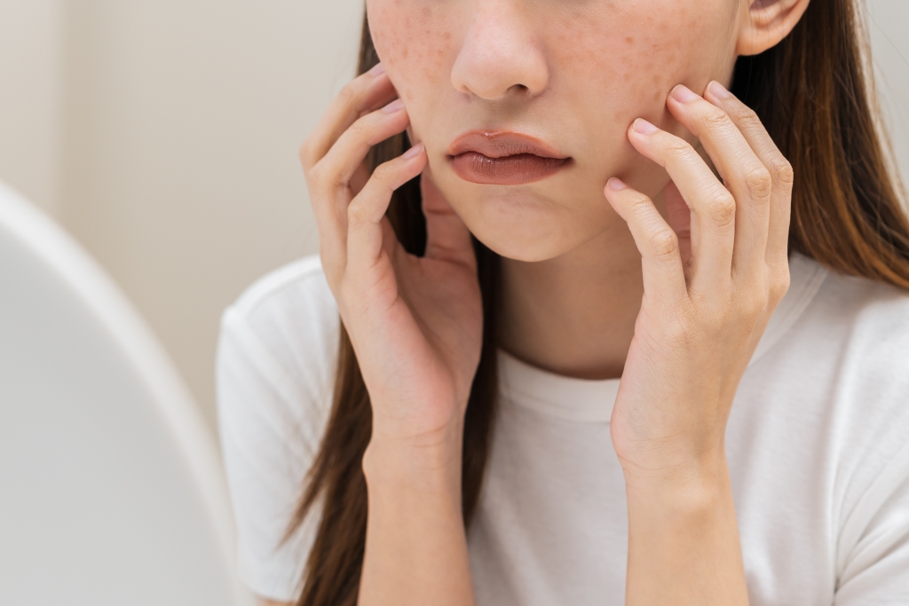 トラネキサム酸での治療を岐阜で検討中の方へ｜効果・適応・内服と外用の違いを解説