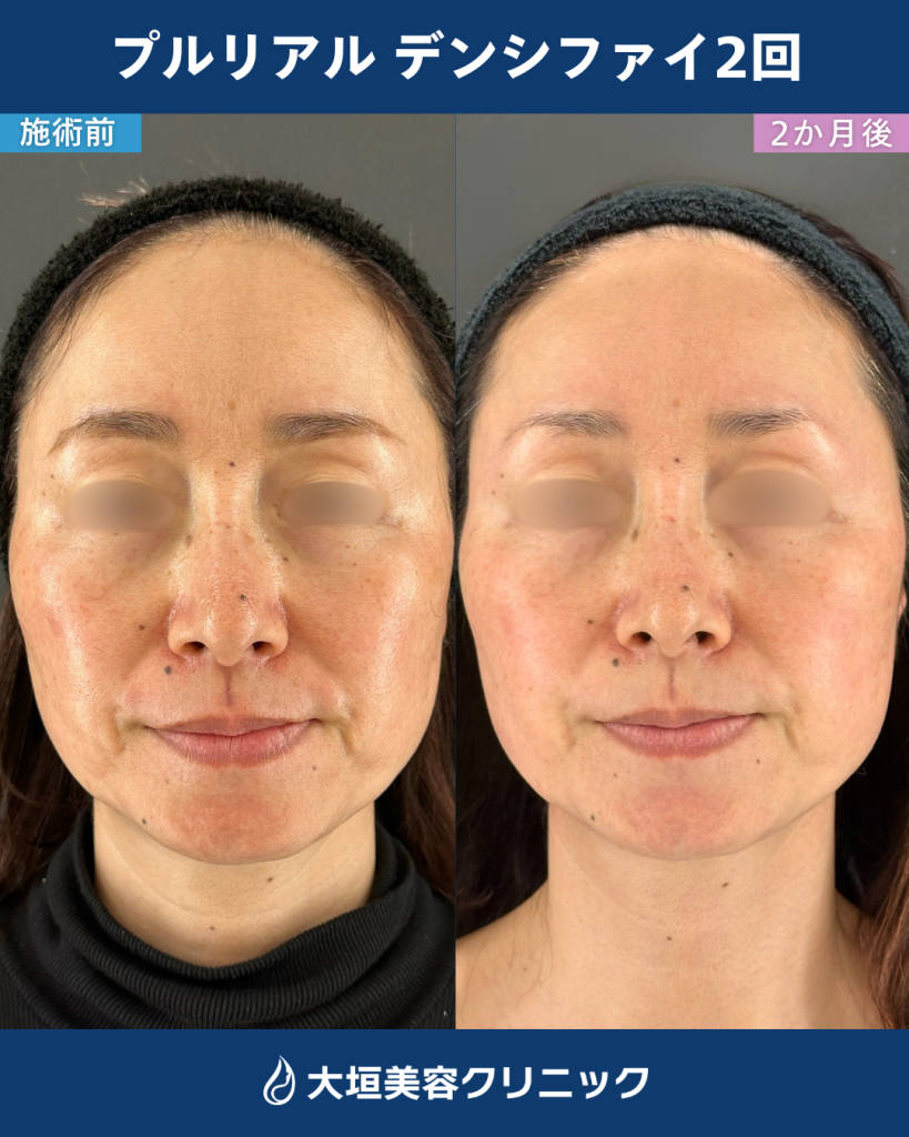 プルリアル（症例1）