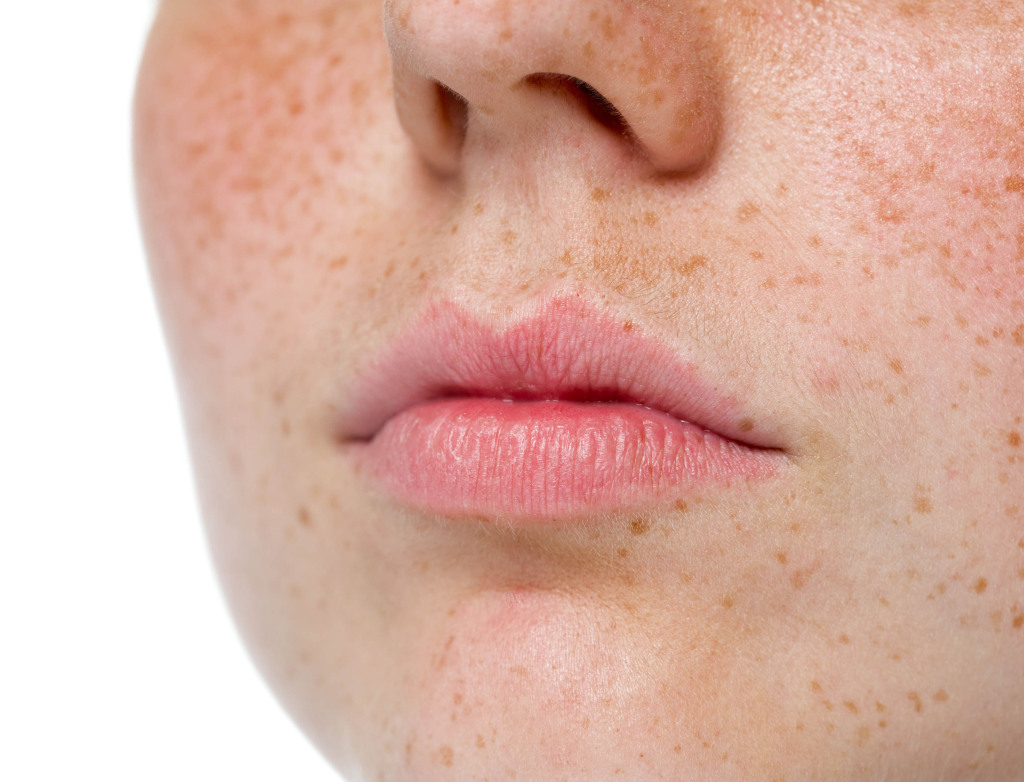 岐阜でそばかすの治療を考えているなら知っておきたいこと｜美容医療で叶える本格アプローチ