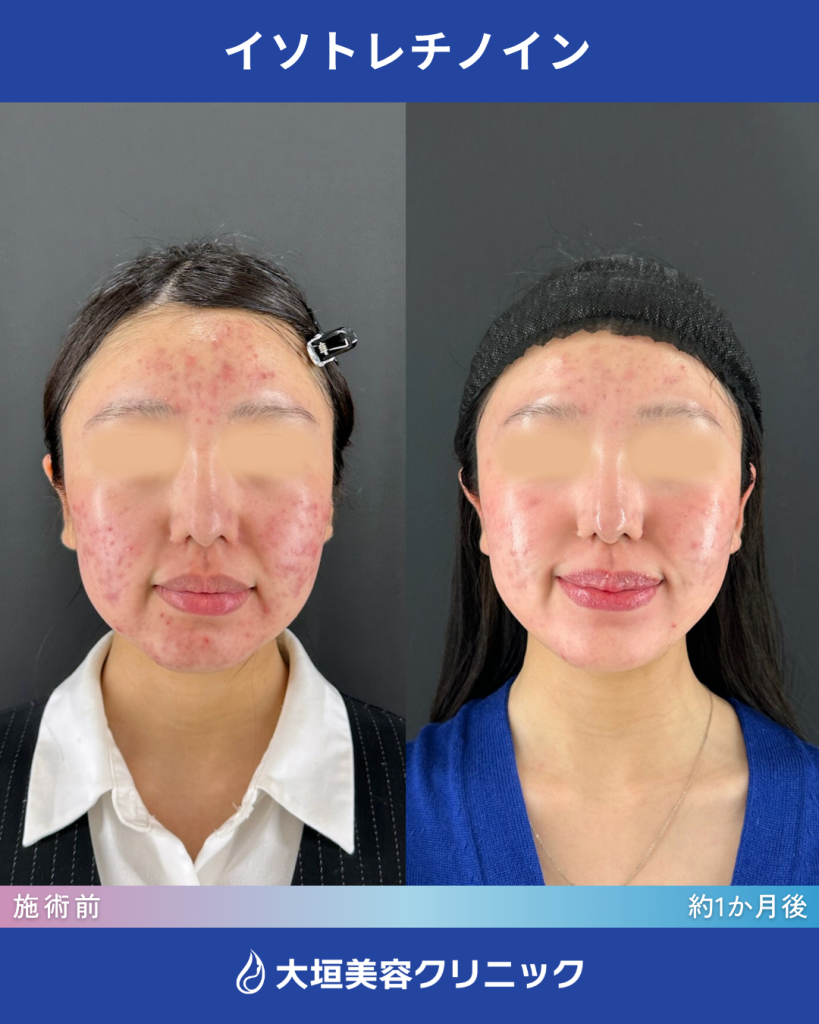 イソトレチノイン（症例1）