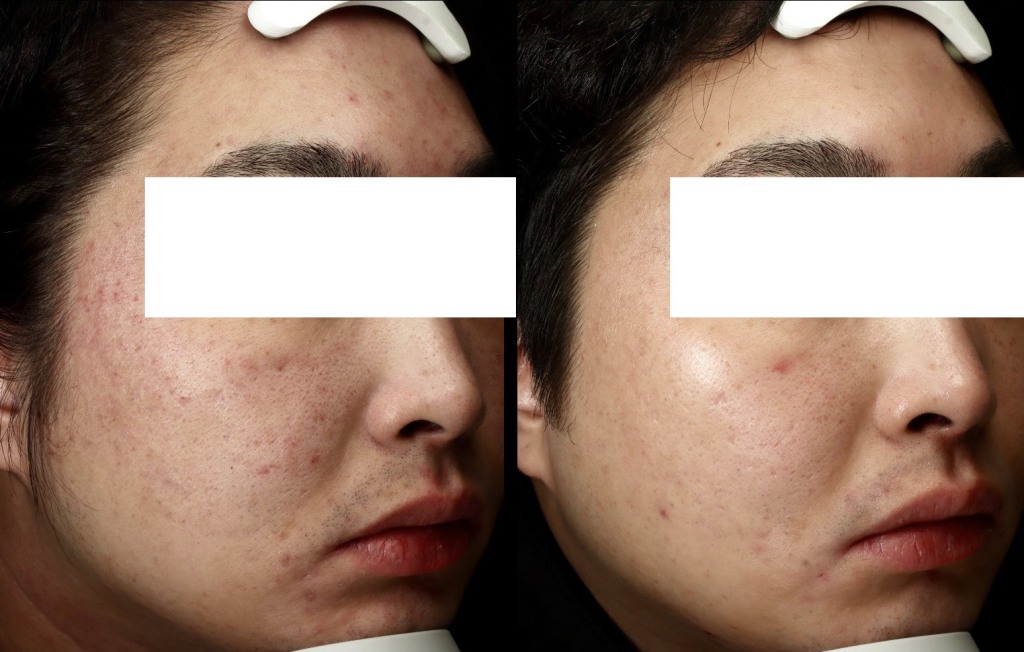 イソトレチノインで大変身！！