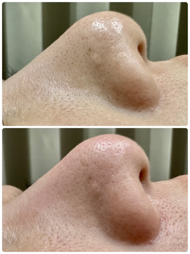 大垣美容クリニックのハイドラフェイシャルはひと味違う💡