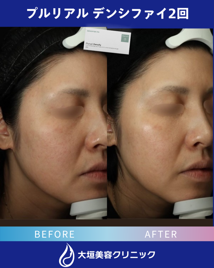 プルリアル（症例2）