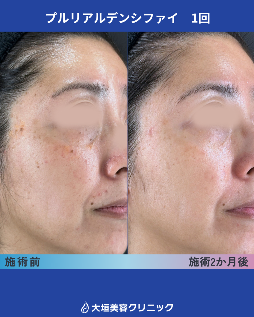 プルリアル（症例4）