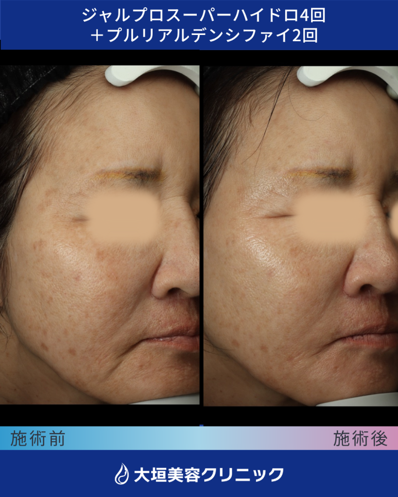 プルリアル（症例3）