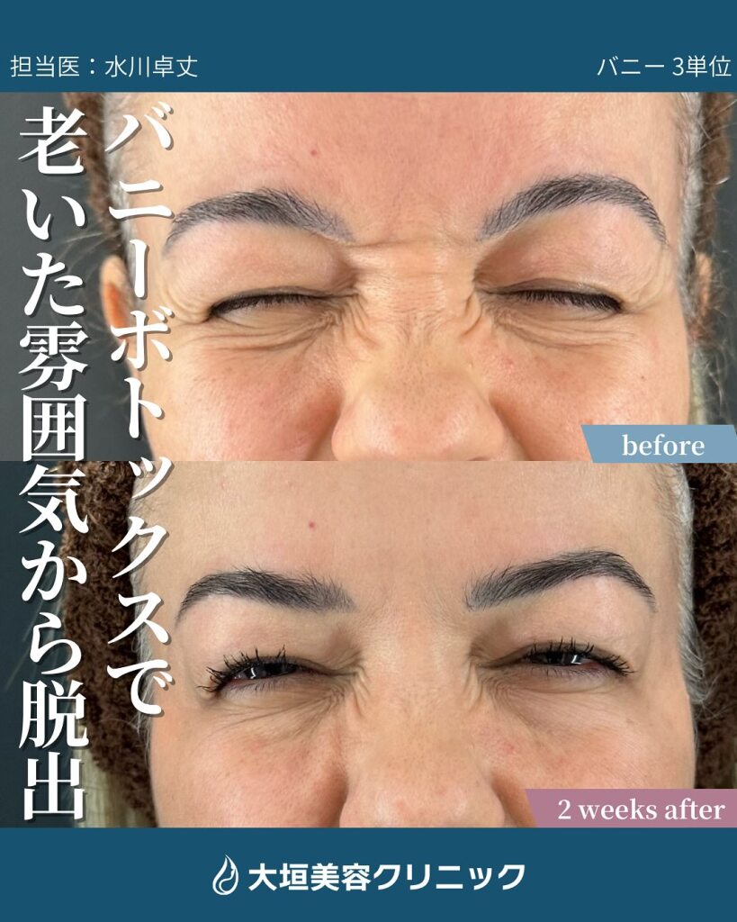 バニーラインのボトックスを岐阜で｜笑うと出る鼻横のシワ、気になっていませんか？