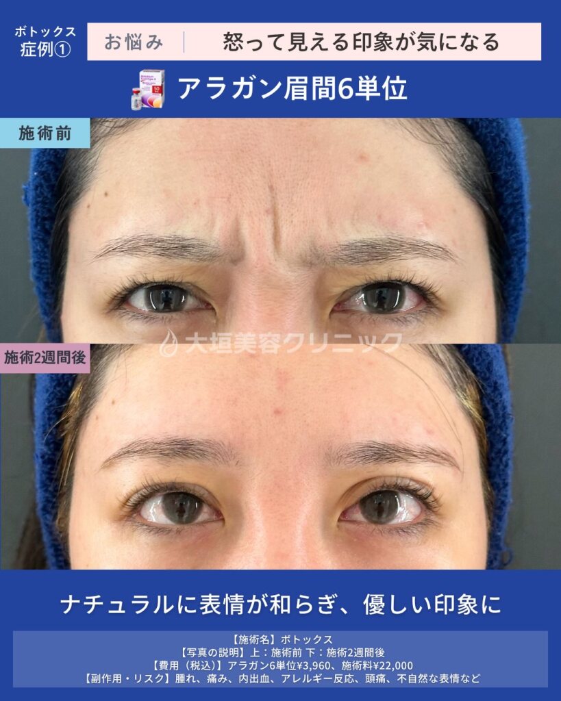 眉間ボトックスを岐阜で検討中の方へ｜怒って見える印象をやわらげる方法とは？効果・経過・注意点も解説