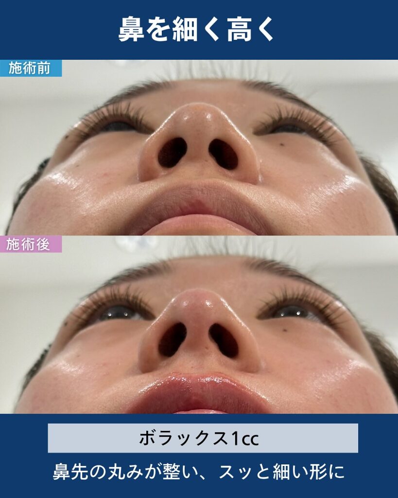 鼻ヒアルロン酸注射｜岐阜・大垣市の美容皮膚科・脱毛の大垣美容クリニック