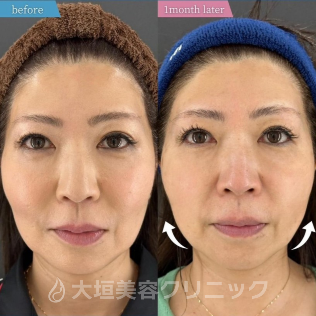 大垣美容クリニックの糸リフトのbefore・after