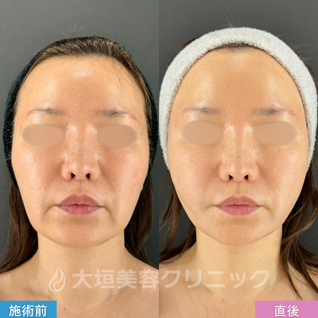 大垣美容クリニックの糸リフトのbefore・after