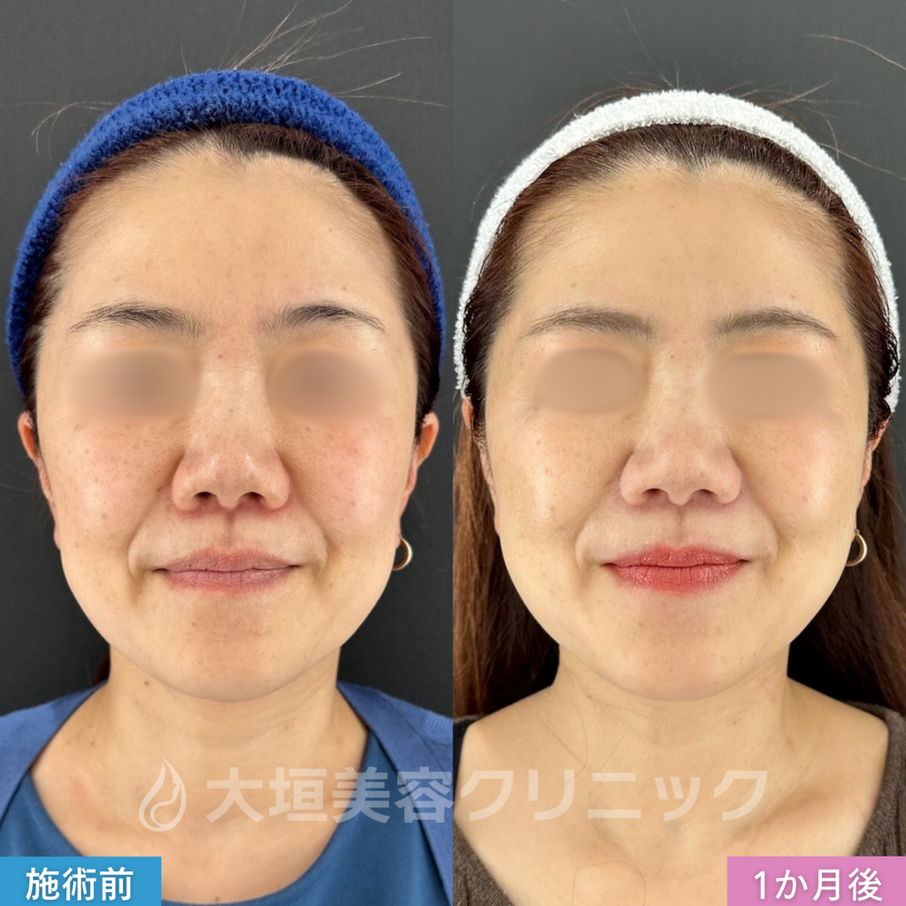 大垣美容クリニックの糸リフトのbefore・after