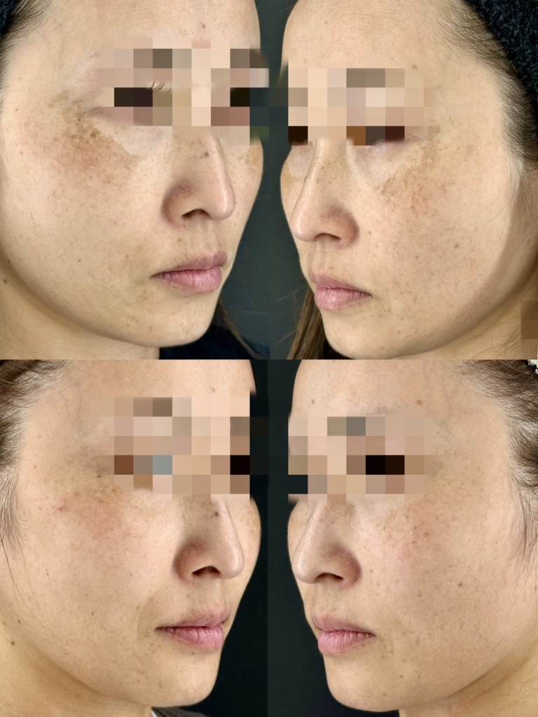 大垣美容クリニックのポテンツァのbefore・after