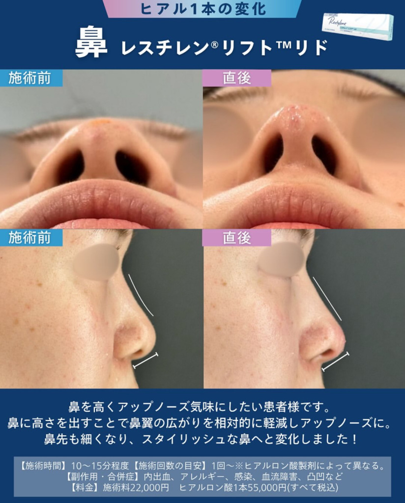 鼻ヒアルロン酸注射