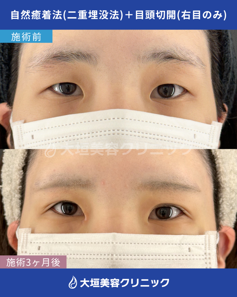 自然癒着法（二重埋没法）、目頭切開（右目のみ）