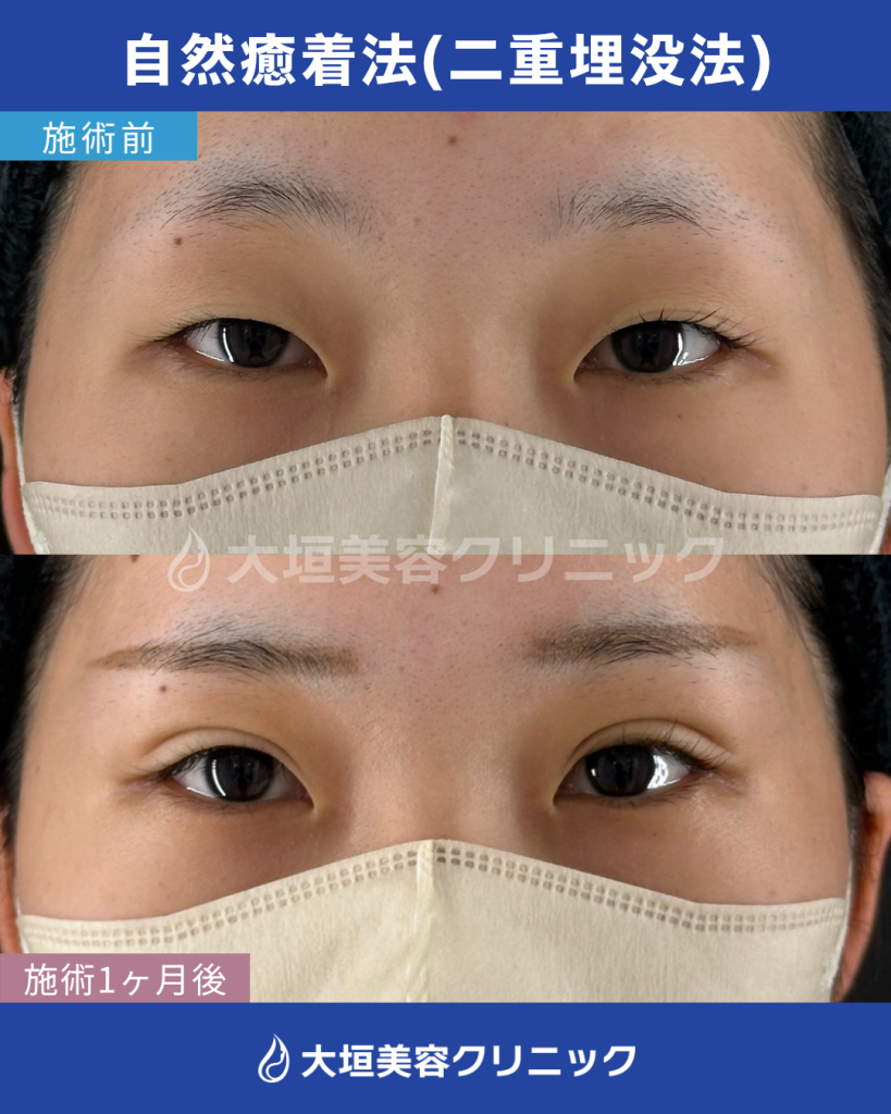 自然癒着法（二重埋没法）