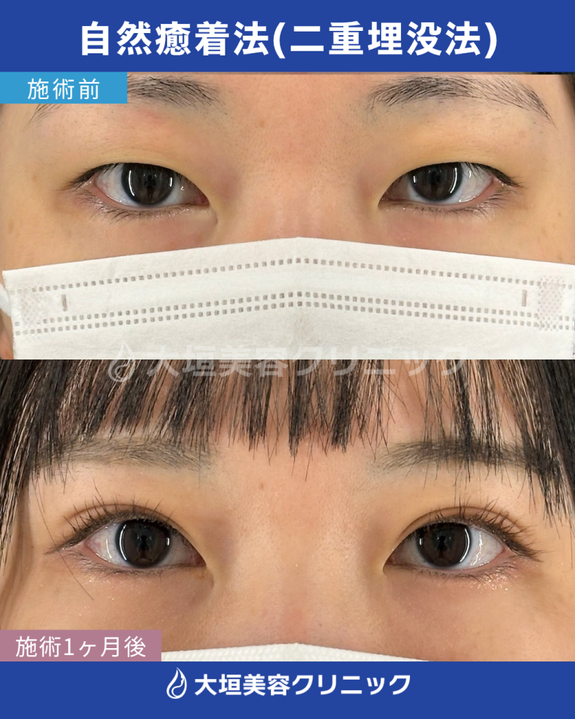 自然癒着法（二重埋没法）