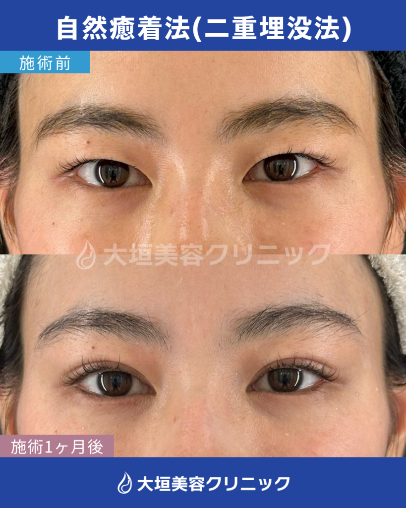 自然癒着法（二重埋没法）
