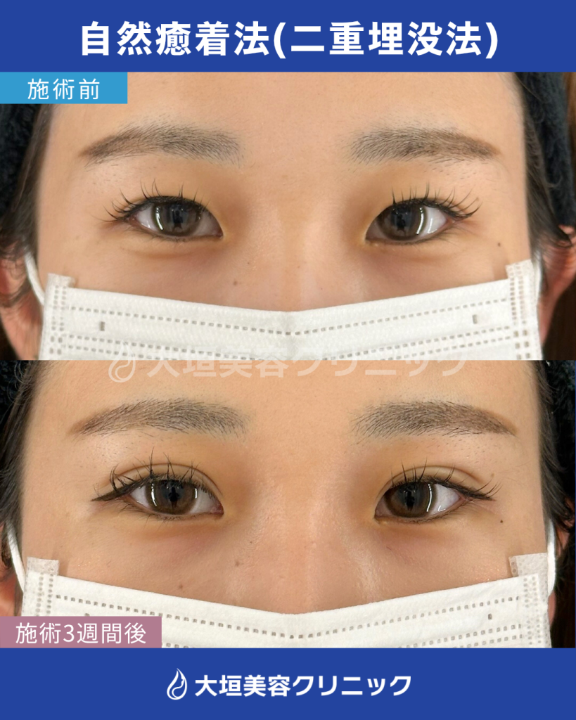 自然癒着法（二重埋没法）