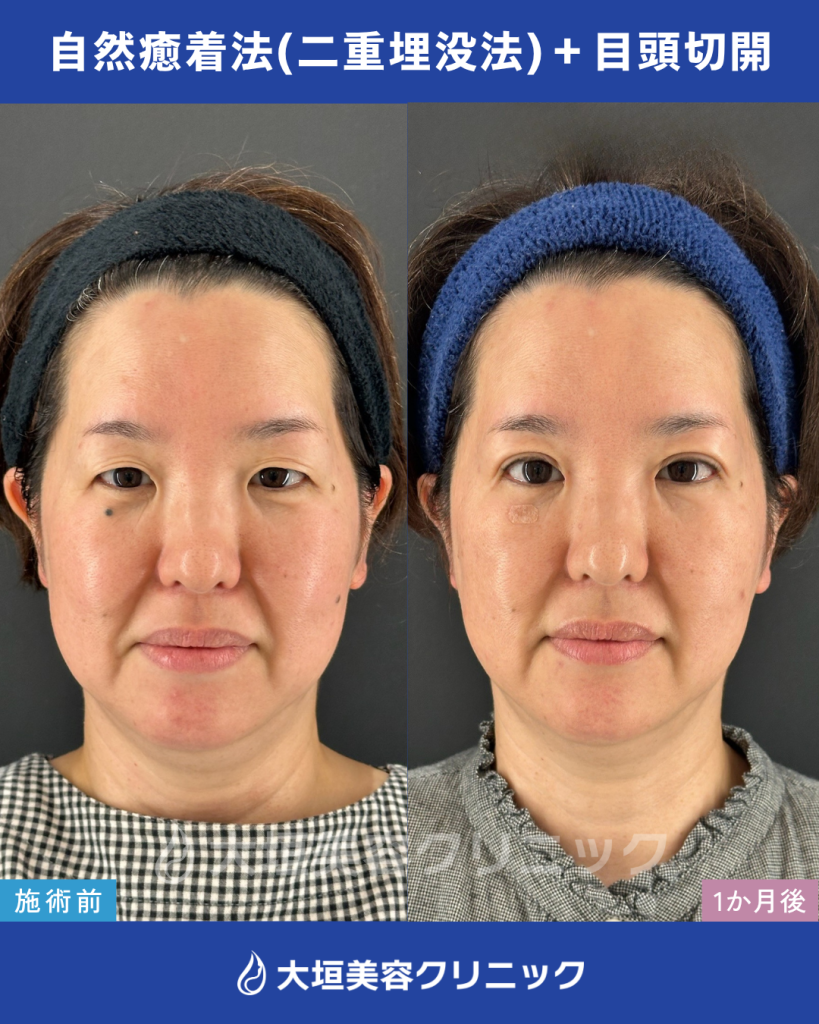 自然癒着法（二重埋没法）、目頭切開