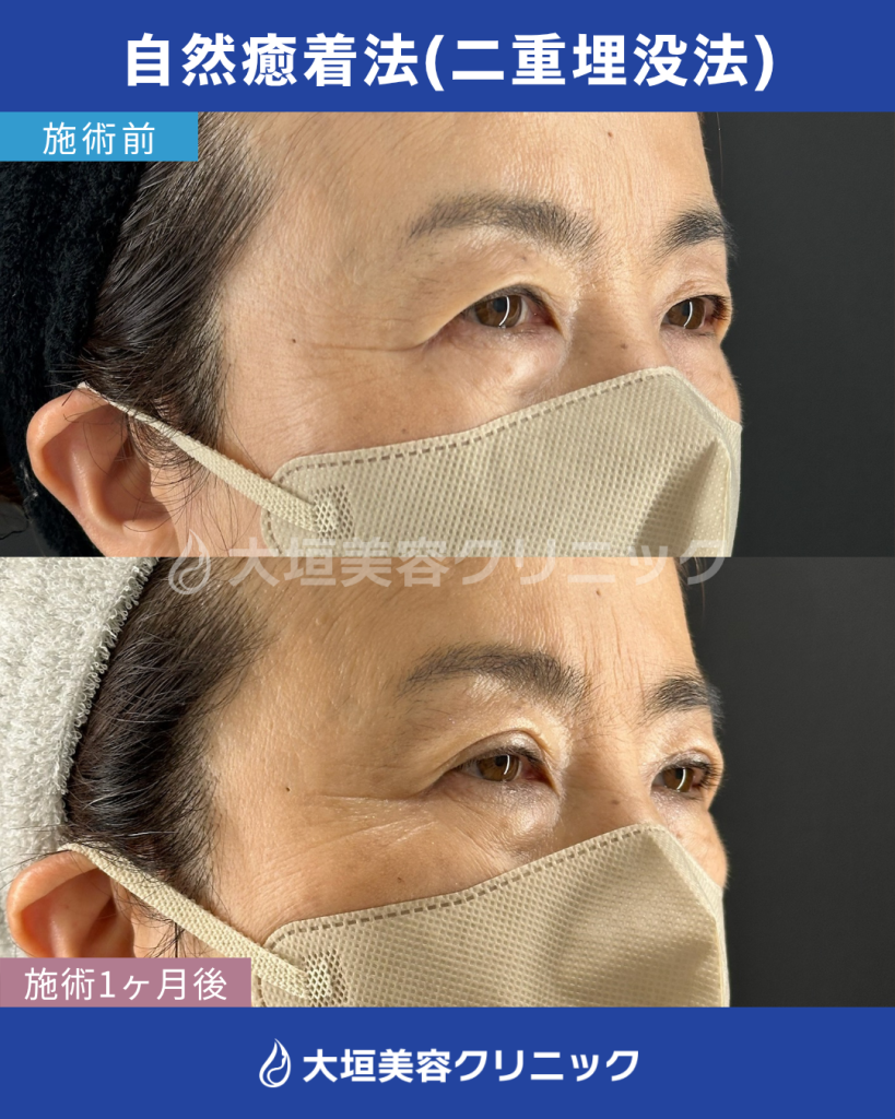 自然癒着法（二重埋没法）
