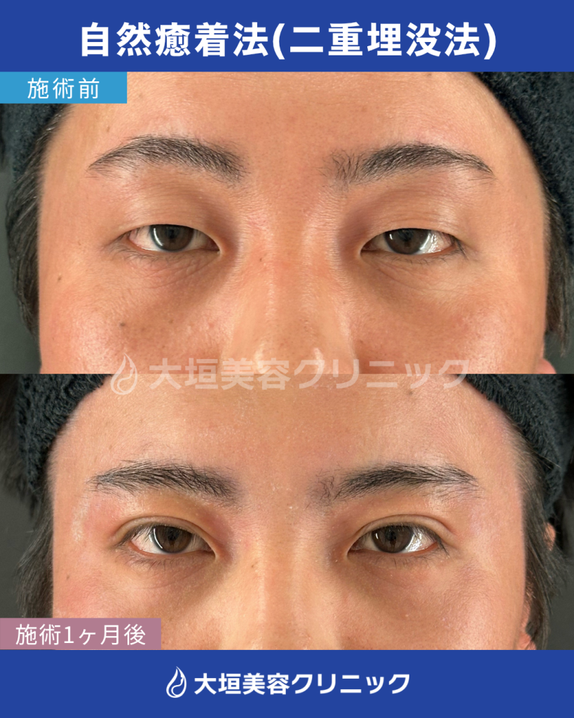 自然癒着法（二重埋没法）