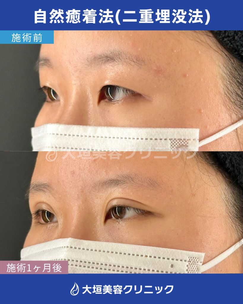 自然癒着法（二重埋没法）