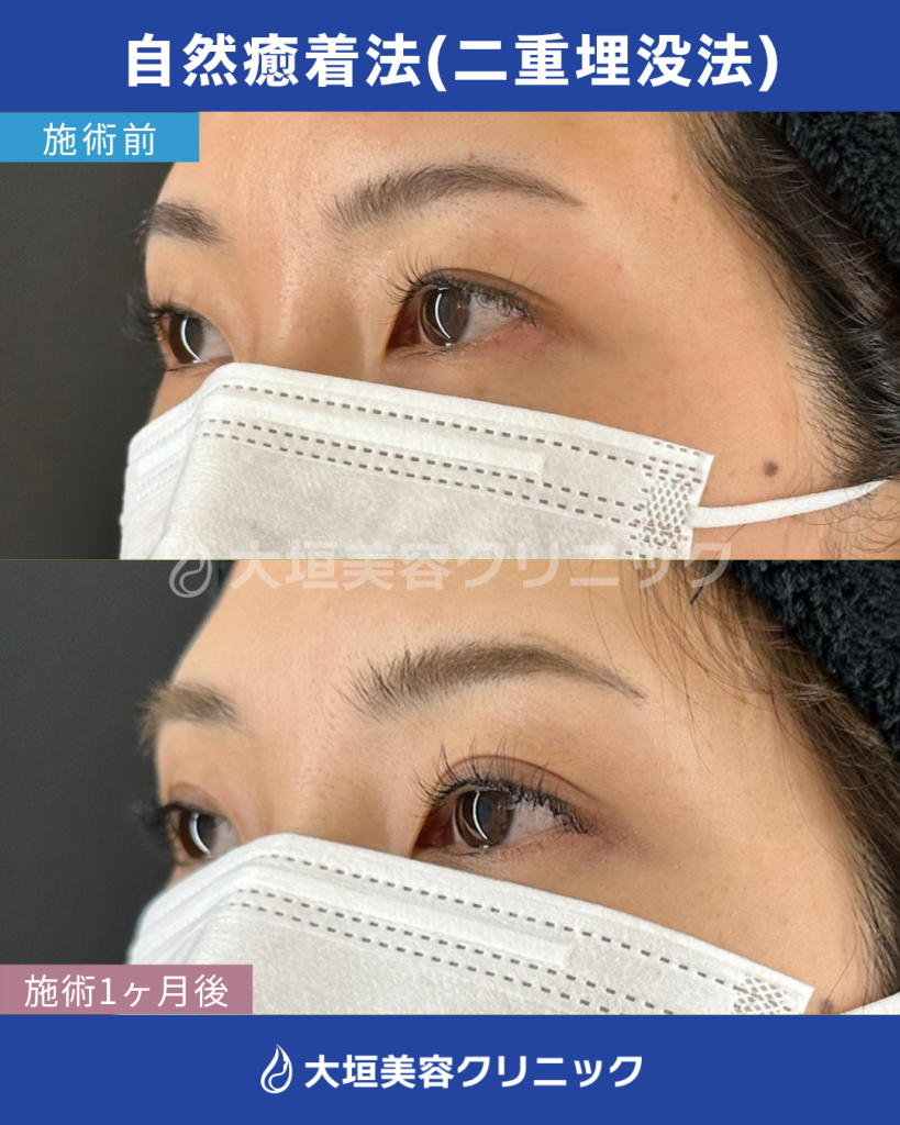 自然癒着法（二重埋没法）