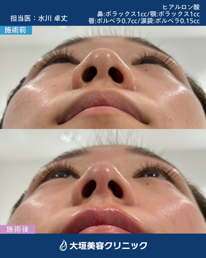 鼻ヒアルロン酸　Dr.水川卓丈