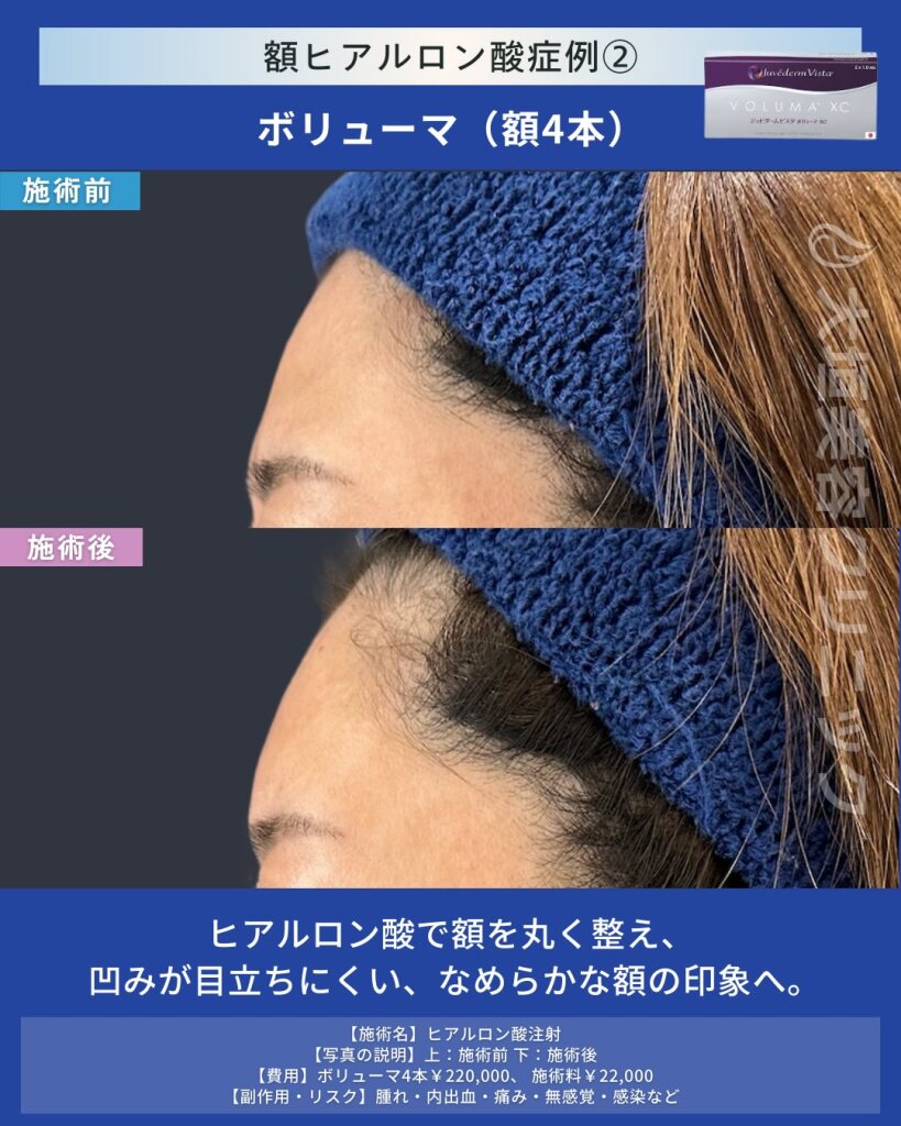 おでこヒアルロン酸注射