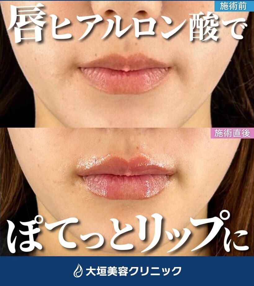 唇ヒアルロン酸注射