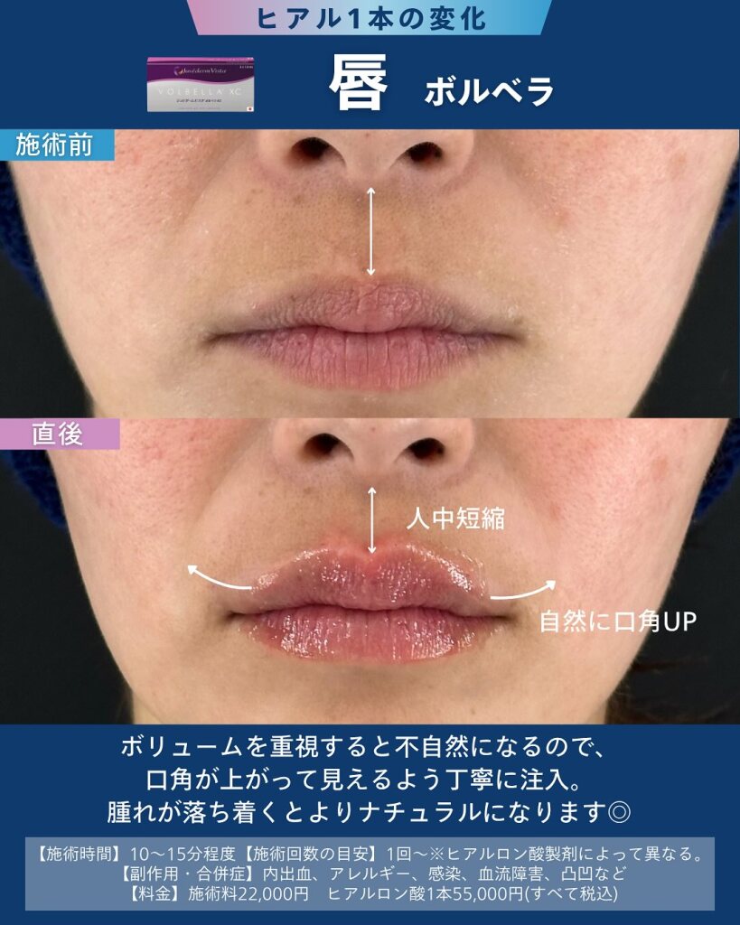 唇ヒアルロン酸注射