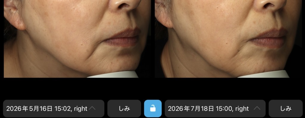 ポテンツァ【ダイヤモンドチップ】×ジャルプロで自然なリフトアップ✨