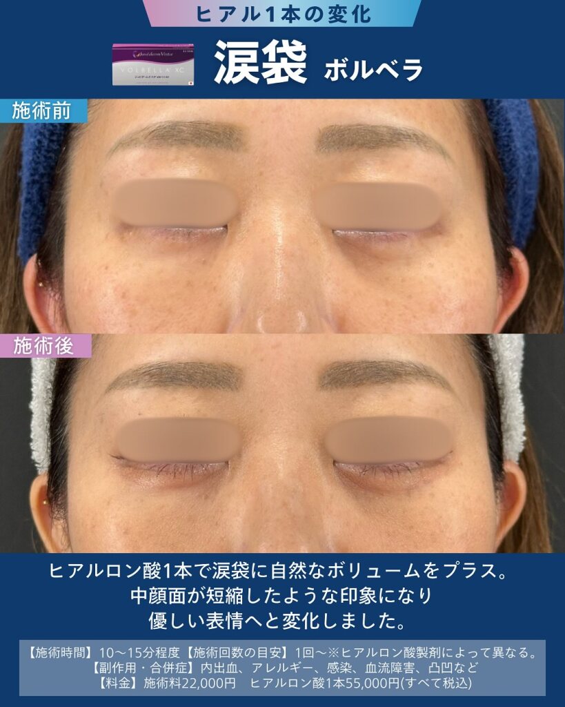 涙袋ヒアルロン酸注射