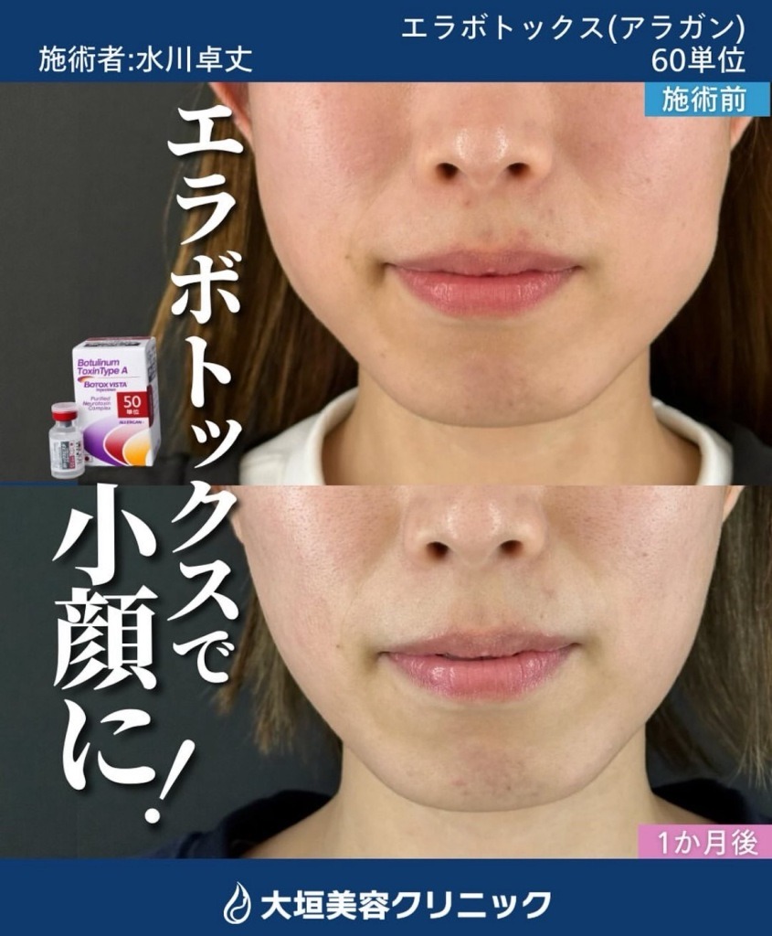 エラボトックス